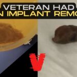 2024年 Exclusive Interview w/ Veteran Who Had Alien Implant Removed