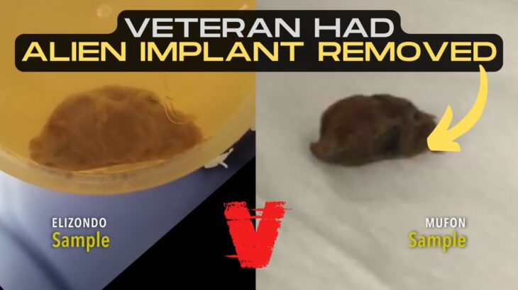 2024年 Exclusive Interview w/ Veteran Who Had Alien Implant Removed